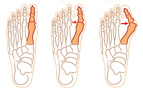 Hallux-valgus-Deformität