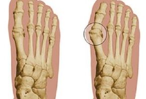 Ursachen des Hallux valgus