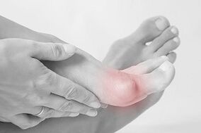 Hallux valgus So wählen Sie Schuhe aus