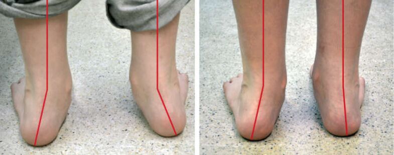 Valgus -Beine