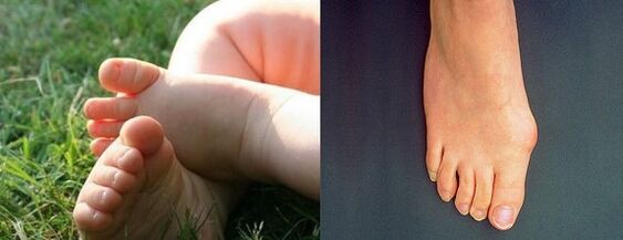 Valgus -Verformung des ersten Fußfingers