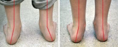 Valgus -Krümmung